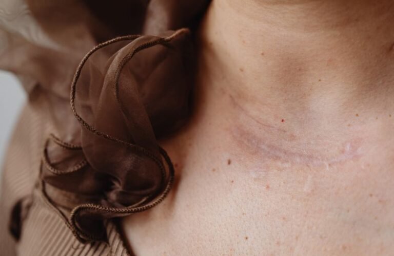 treatment for kp skin